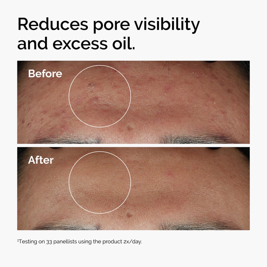 Niacinamide 10% + Zinc 1% Acne Pores Oil Control Face Serum - Image 4